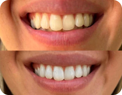 Antes e depois do clareamento dental - dentes mais brancos