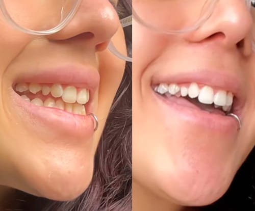 Julia C. antes e depois do clareamento