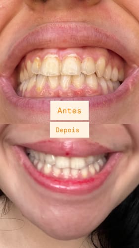 Ana Livia P. antes e depois